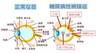 糖尿病